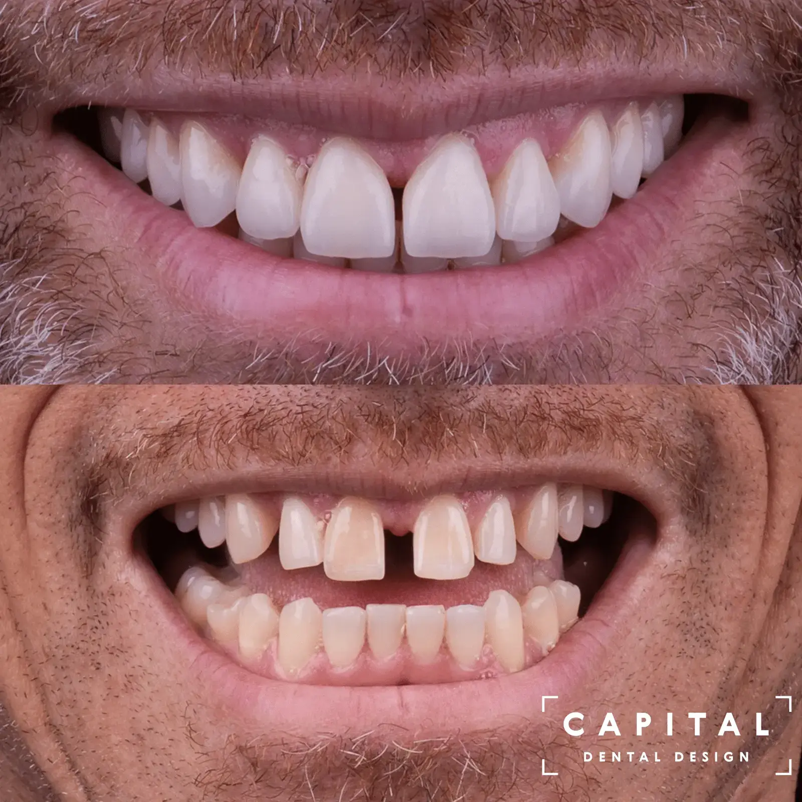 Porcelain veneers final result