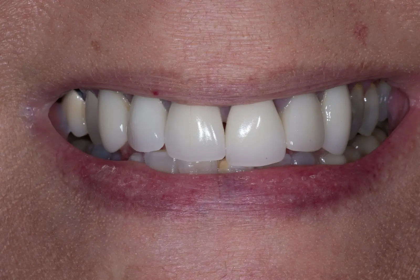 Crowns case at Capital Dental Design