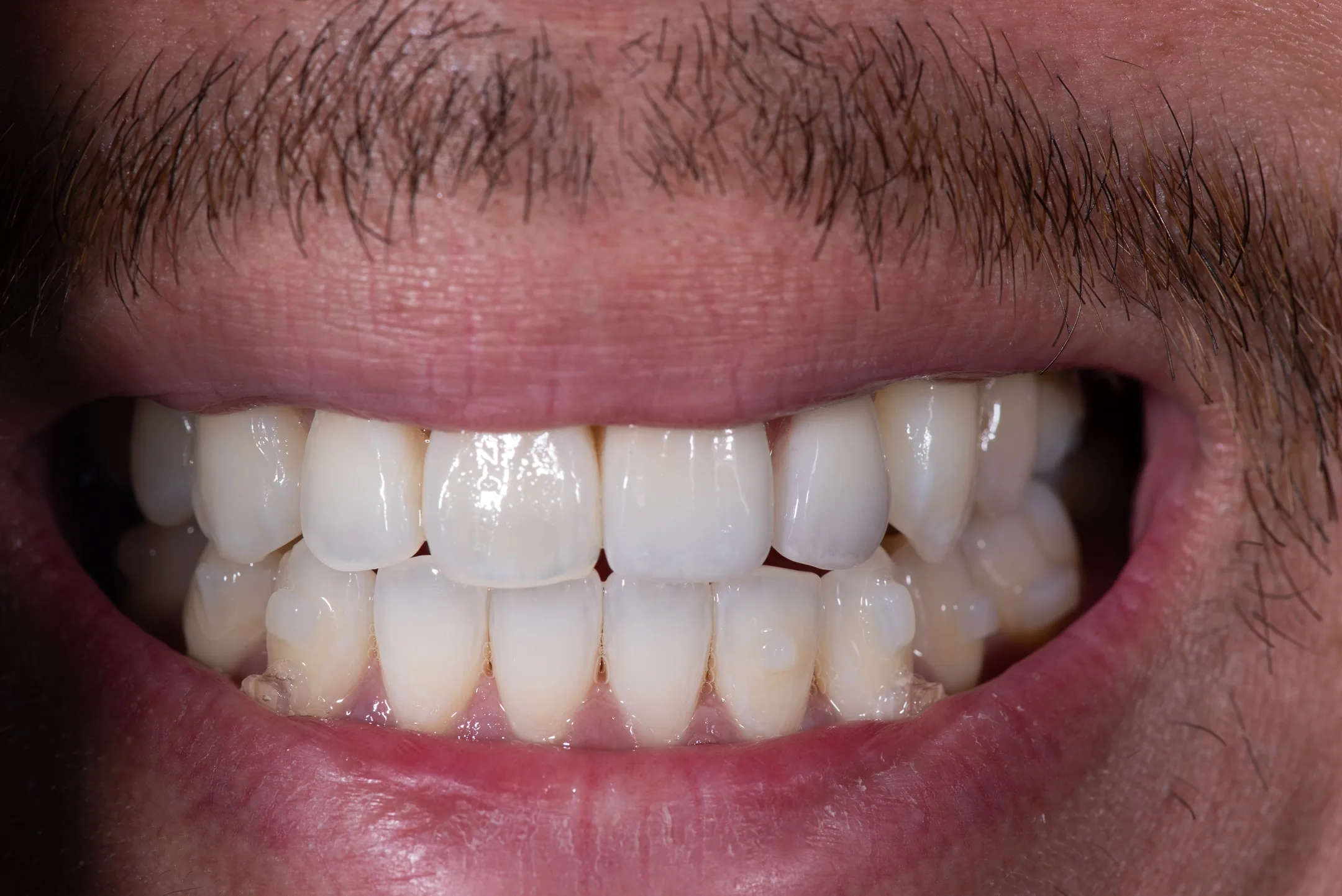 Implant Prosthetics case at Capital Dental Design