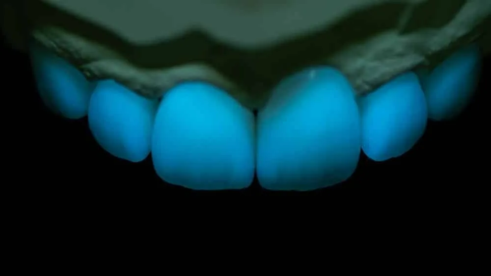 Case 07: Porcelain Veneers