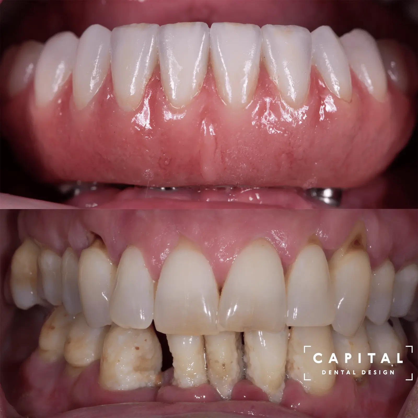 All-on-4 Dental Implants treatment at Capital Dental Design Richmond VA
